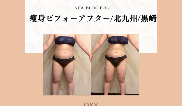 痩身ビフォーアフター/北九州/黒崎