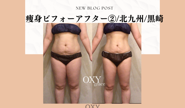 痩身ビフォーアフター②/北九州/黒崎