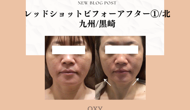レッドショットビフォーアフター①/北九州/黒崎